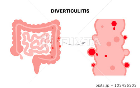 Diverticulitis and diverticulosis 105456505