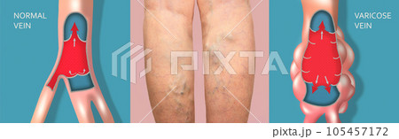 Varicose Veins On A Female Senior Legs. The Structure Of Normal