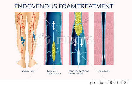 Varicose Veins. Endovenous foam Treatment. Structure of vein 105462123