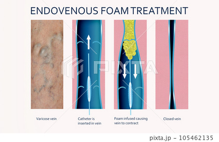 Endovenous laser treatment for varicose veins - foam sclerotherapy concept. 105462135
