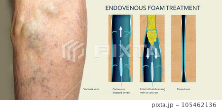 Endovenous laser treatment for varicose veins - foam sclerotherapy concept. 105462136