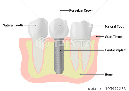 インプラントの歯と天然歯が並ぶイラスト 105472278