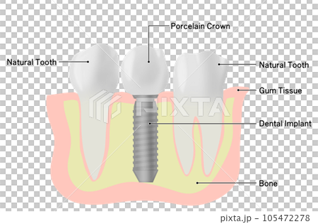 インプラントの歯と天然歯が並ぶイラスト 105472278