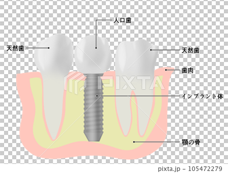 種植牙和天然牙的插圖 105472279