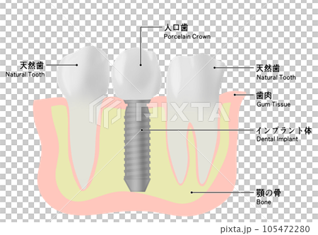 種植牙和天然牙的插圖 種植牙和天然牙的插圖 105472280