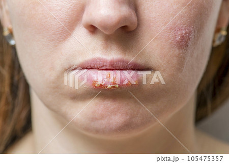 Close up of female lips affected by herpes virus. Close up of female lips affected by herpes virus. 105475357