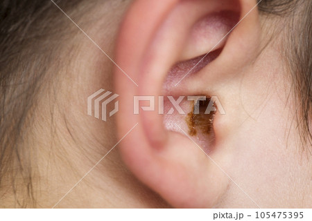 Earwax in the dirty ear of child. Hole ear of human, wax on hair and skin of ear 105475395