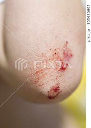 子供の肘の擦り傷イメージ 105480995