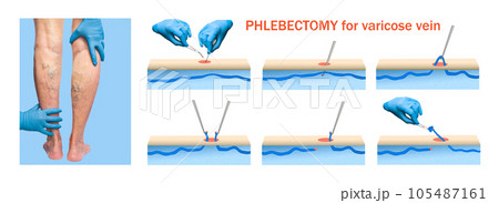 Ambulatory Phlebectomy Treatment for varicose vein. Ambulatory Phlebectomy Treatment for varicose vein. 105487161
