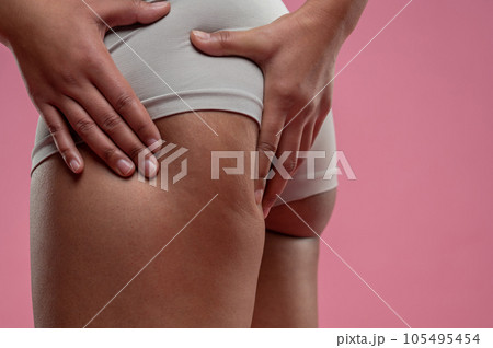 Close up of woman checking her legs on cellulitis Close up of woman checking her legs on cellulitis 105495454