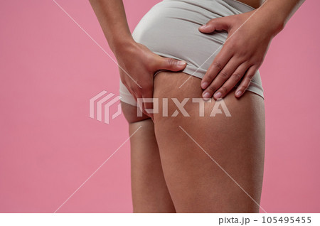 Close up of woman checking her legs on cellulitis 105495455