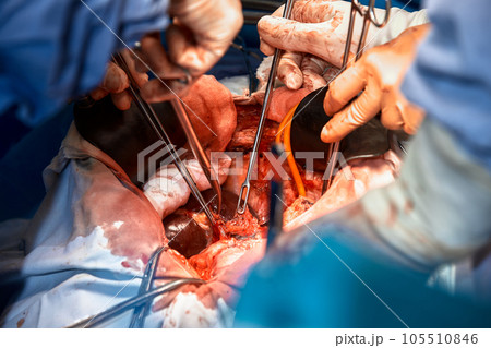Close-up of the hands of surgeons performing a complex surgical operation in the open cavity of the patient's chest. Use of surgical instruments and clamps. Precision medicine, saving patient's life. Close-up of the hands of surgeons performing a complex surgical operation in the open cavity of the patient's chest. Use of surgical instruments and clamps. Precision medicine, saving patient's life. 105510846