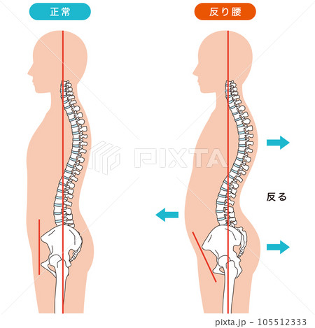 反り腰の姿勢　比較 105512333