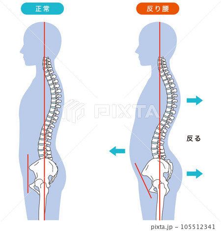 反り腰の姿勢 比較 反り腰の姿勢 比較 105512341