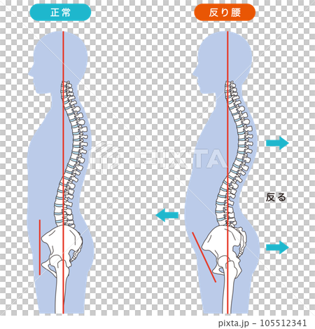 反り腰の姿勢 比較 反り腰の姿勢 比較 105512341