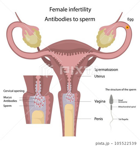 Female infertility. Antibodies to sperm. Female infertility. Antibodies to sperm. 105522539