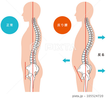 反り腰の姿勢　比較 105524720