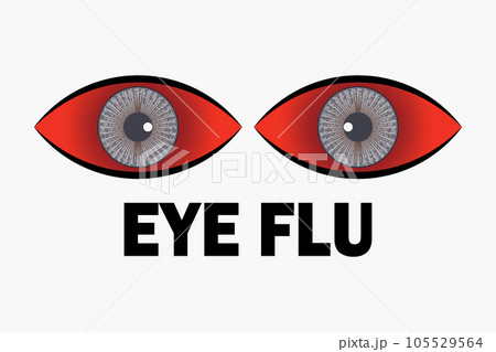 Conjunctivitis virus affected red eye,eye flu...のイラスト素材 [105529564] - PIXTA