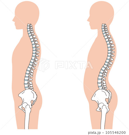 反り腰の姿勢 比較 反り腰の姿勢 比較 105546200