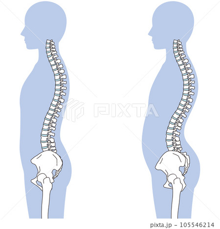反り腰の姿勢 比較 反り腰の姿勢 比較 105546214