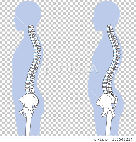 反り腰の姿勢 比較 反り腰の姿勢 比較 105546214