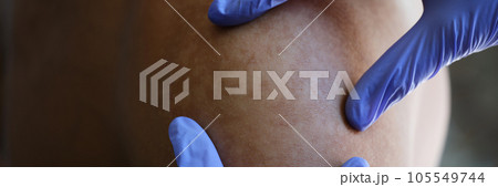 Doctor examines skin disease of his patient close-up. Doctor examines skin disease of his patient close-up. 105549744