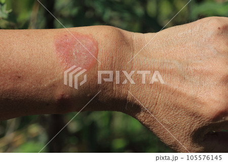 毛虫に刺された痕=その後 毛虫に刺された痕=その後 105576145