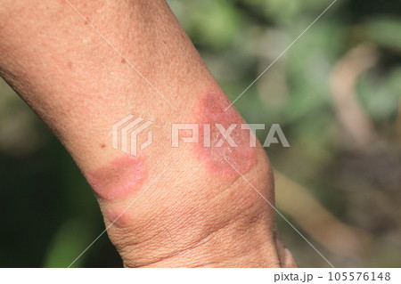 毛虫に刺された痕=その後 毛虫に刺された痕=その後 105576148