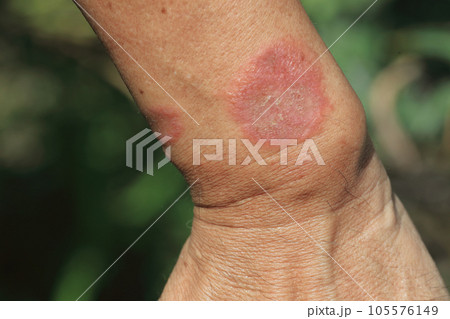 毛虫に刺された痕=その後 毛虫に刺された痕=その後 105576149