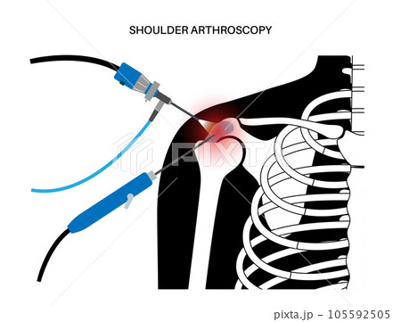 Shoulder arthroscopy poster Shoulder arthroscopy poster 105592505