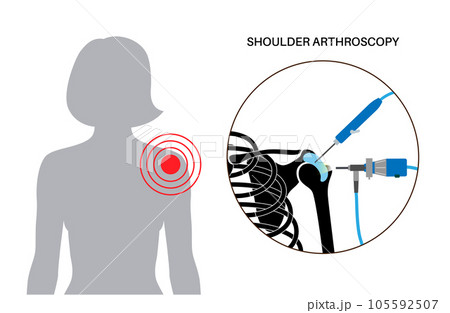 Shoulder arthroscopy poster 105592507