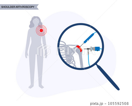 Shoulder arthroscopy poster 105592508