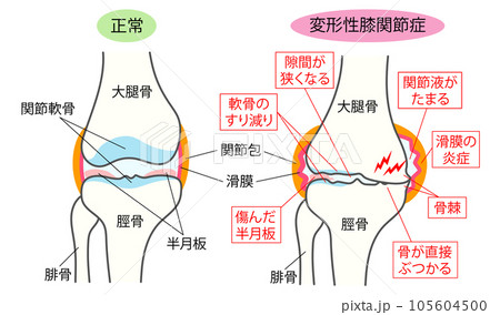 正常な膝関節と変形性膝関節症の比較説明イラスト 正常な膝関節と変形性膝関節症の比較説明イラスト 105604500
