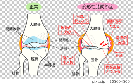 正常な膝関節と変形性膝関節症の比較説明イラスト 正常な膝関節と変形性膝関節症の比較説明イラスト 105604500