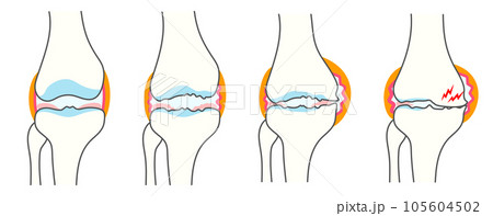 正常な膝関節と変形性膝関節症の進行度別比較イラスト 正常な膝関節と変形性膝関節症の進行度別比較イラスト 105604502