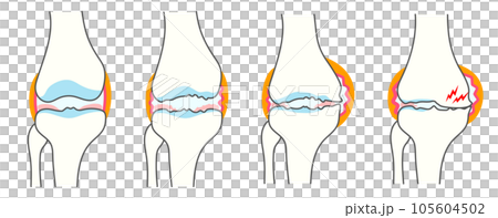 正常な膝関節と変形性膝関節症の進行度別比較イラスト 正常な膝関節と変形性膝関節症の進行度別比較イラスト 105604502