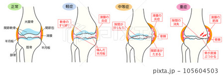 正常な膝関節と変形性膝関節症の進行度別比較説明イラスト 正常な膝関節と変形性膝関節症の進行度別比較説明イラスト 105604503