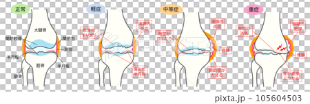 正常な膝関節と変形性膝関節症の進行度別比較説明イラスト 正常な膝関節と変形性膝関節症の進行度別比較説明イラスト 105604503