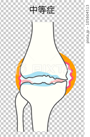 中等症の変形性膝関節症のイラスト 105604513