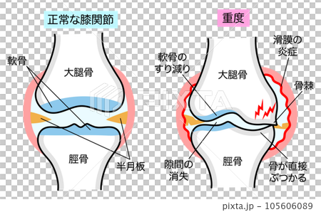 正常膝關節與膝骨關節炎的簡單解釋比較圖 105606089