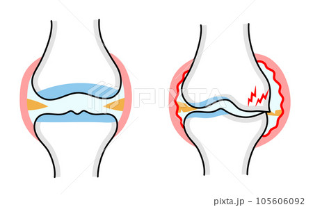 正常な膝関節と変形性膝関節症のシンプルな比較イラスト 105606092