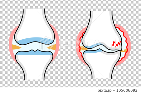正常な膝関節と変形性膝関節症のシンプルな比較イラスト 105606092