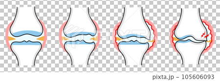 Simple illustration of knee osteoarthritis by progression Simple illustration of knee osteoarthritis by progression 105606093