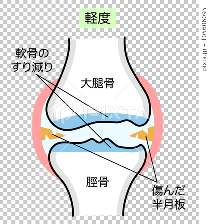 輕度膝骨關節炎的簡單說明 105606095