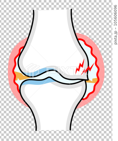 嚴重膝骨關節炎的簡單說明 105606096