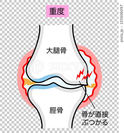 嚴重膝骨關節炎的簡單說明圖 105606097