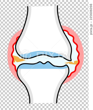 中度膝骨關節炎的簡單說明 105606098