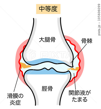 中等度の変形性膝関節症のシンプルなイラスト 105606099