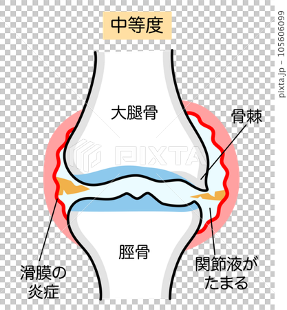 中等度の変形性膝関節症のシンプルなイラスト 105606099