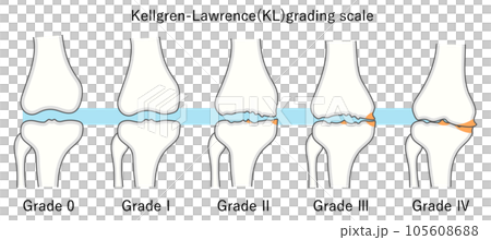 Illustration of the Kellgren-Lawrence Classification of Knee Osteoarthritis 105608688